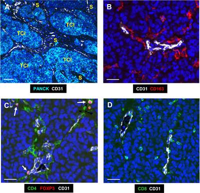 Changes in the immune landscape of TNBC after neoadjuvant chemotherapy: correlation with relapse